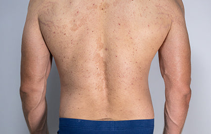 Can Tinea Versicolor Spread?