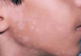 Will Tinea Versicolor Go Away By Itself?