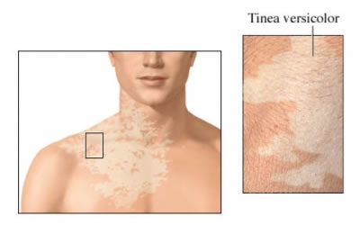 Is Tinea Contagious?
