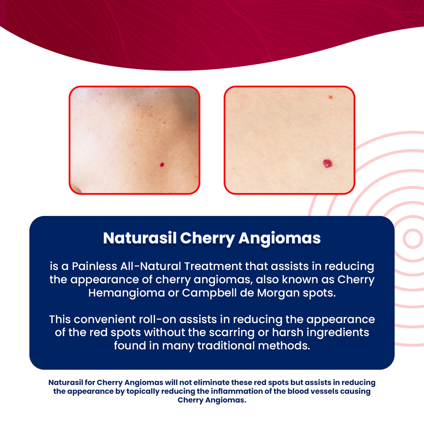 Cherry Angiomas Treatment | Roll-on 10 mL