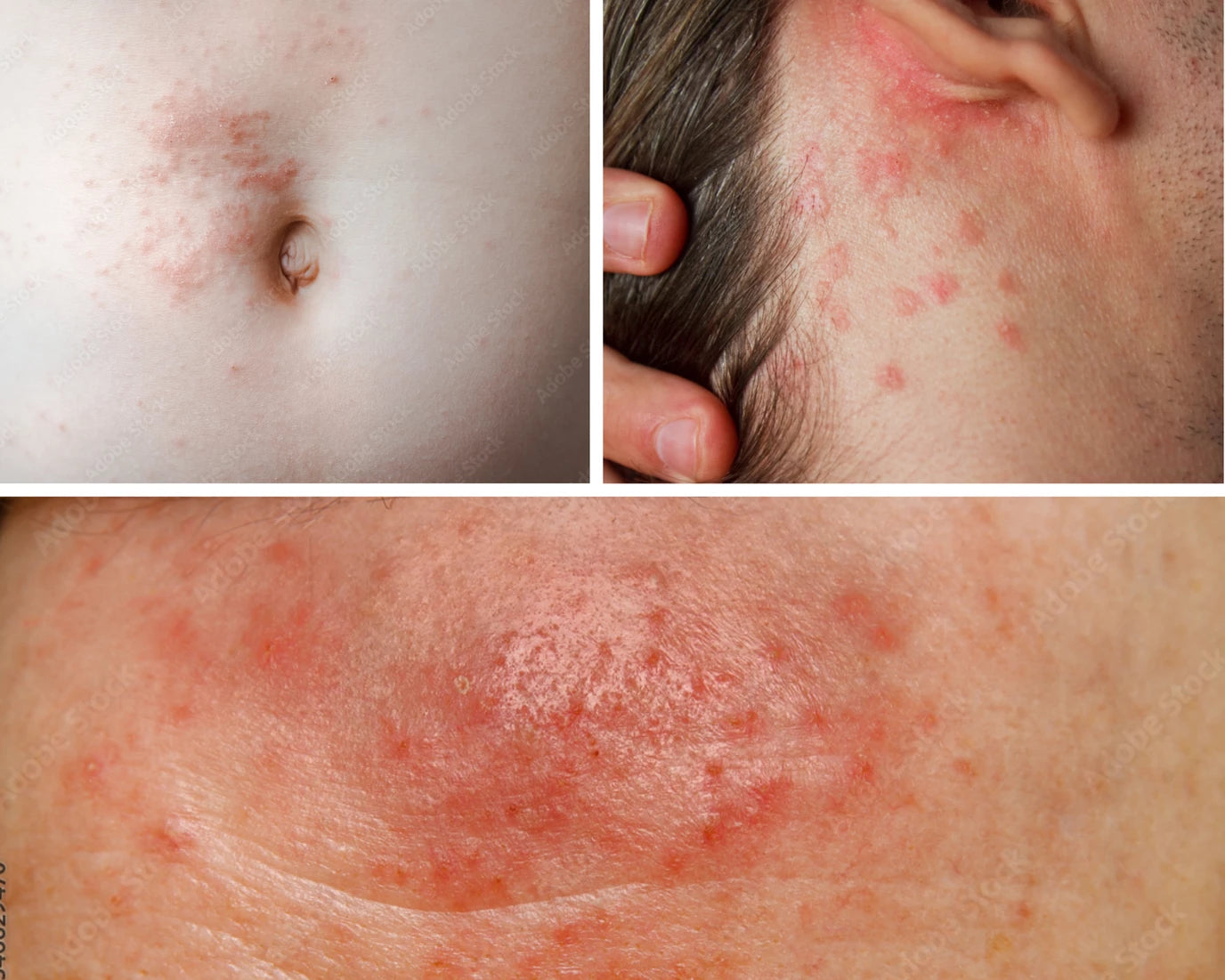 Mite-B-Gone Sulfur 4oz Lotion + 2 Soap Bundle