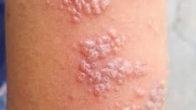 What is Scabies?