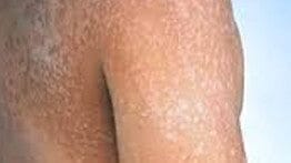 White Spots On Your Skin? Could Be Tinea