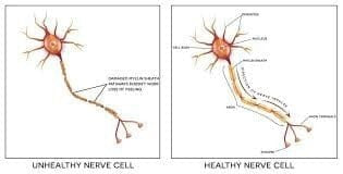 What is Neuropathy? Nervous System Damage