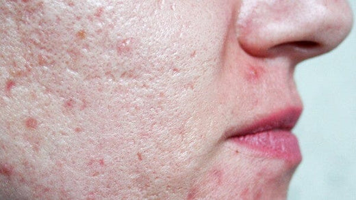 The Ugly Truth About Acne