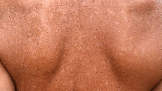 How Do You Get Tinea Versicolor