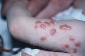Nodular Scabies Cause and Treatment Options