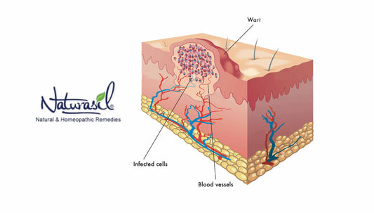 Plantar Warts: Causes, Symptoms, and How to Identify Them