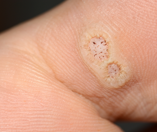 Over-the-Counter Treatments for Plantar Warts: What You Need to Know