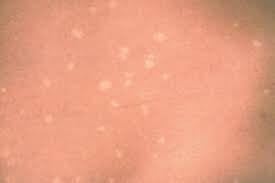 Is Tinea Versicolor Contagious?