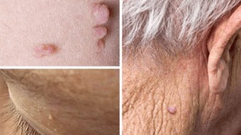 Skin Tags - Frequently Asked Question