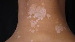 How Do I Get Rid of Tinea Versicolor?