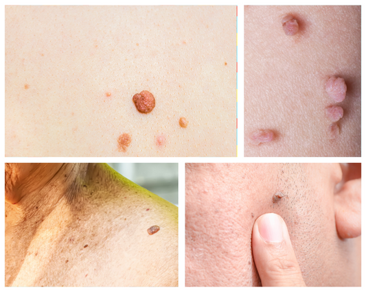 How to Get Rid of Skin Tags