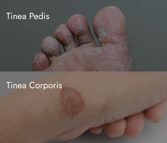 What is Athlete’s Foot (Tinea Pedis), and How Do I Treat It?