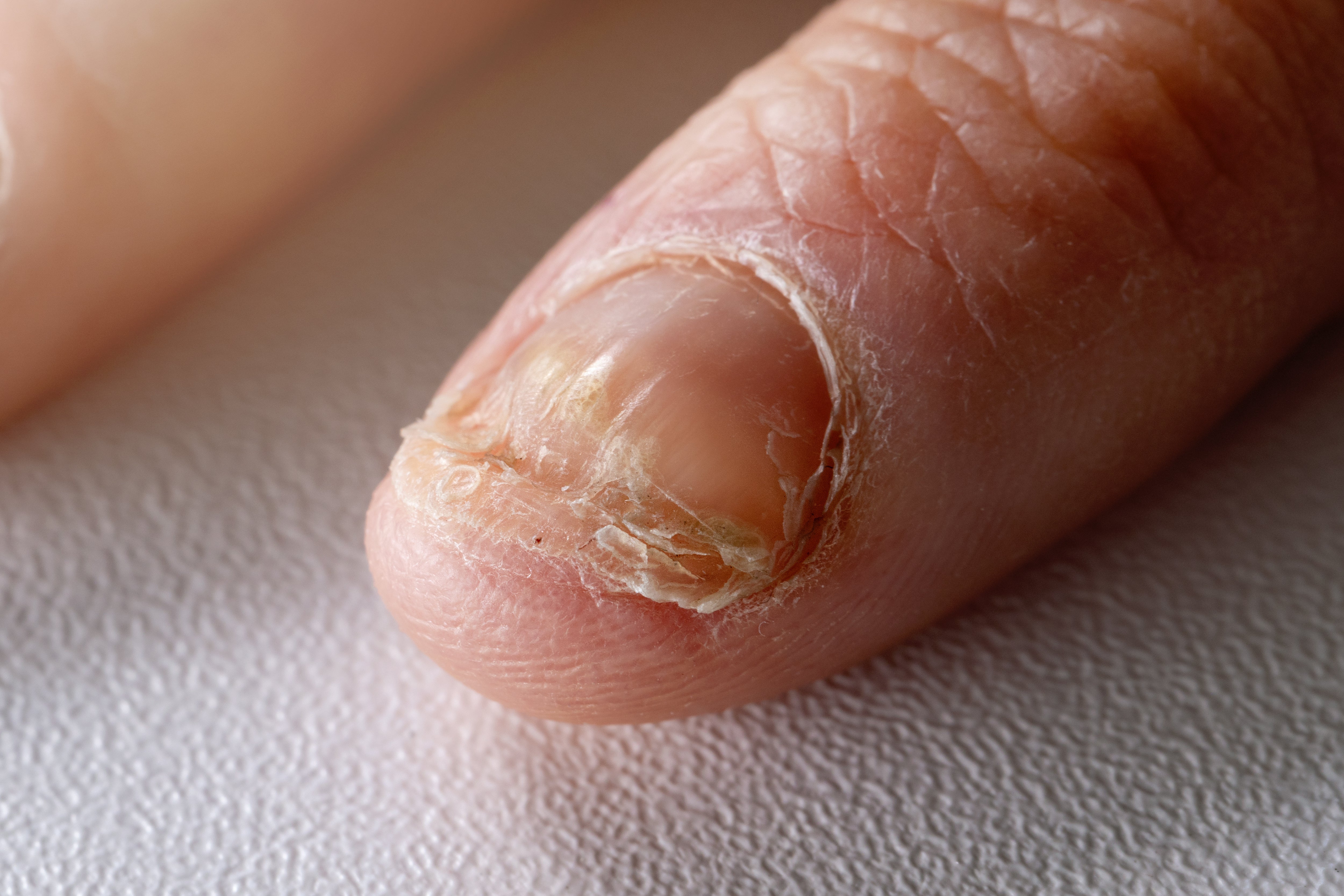 Why is my nail green? Pseudomonas & How to treat it? - YouTube