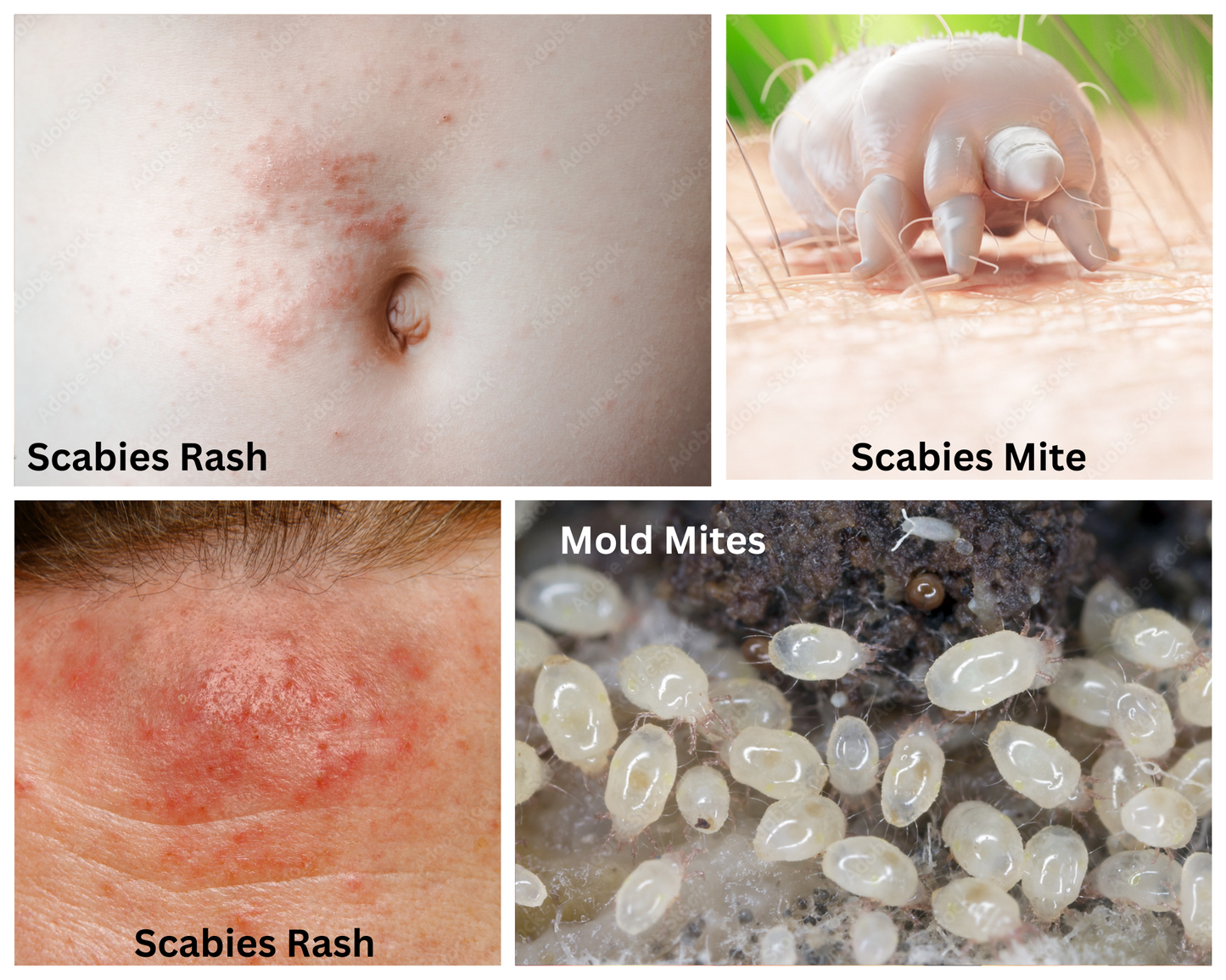 Scabies Treatment Starter Pack