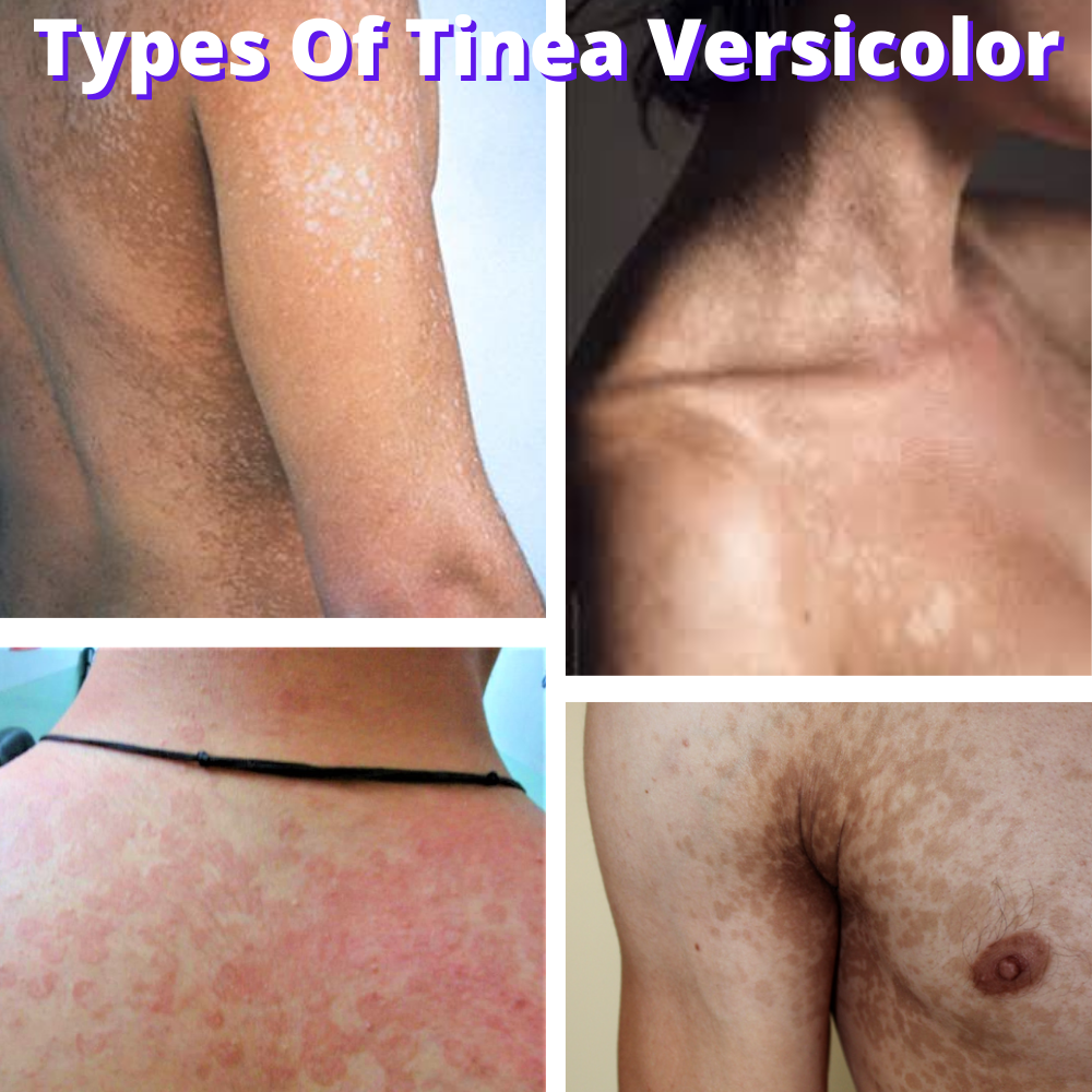 Tinea Versicolor Treatment Value Pack