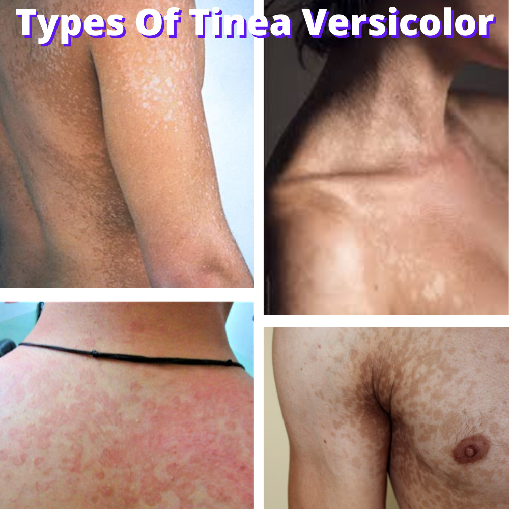 Tinea Versicolor Total Control Pack