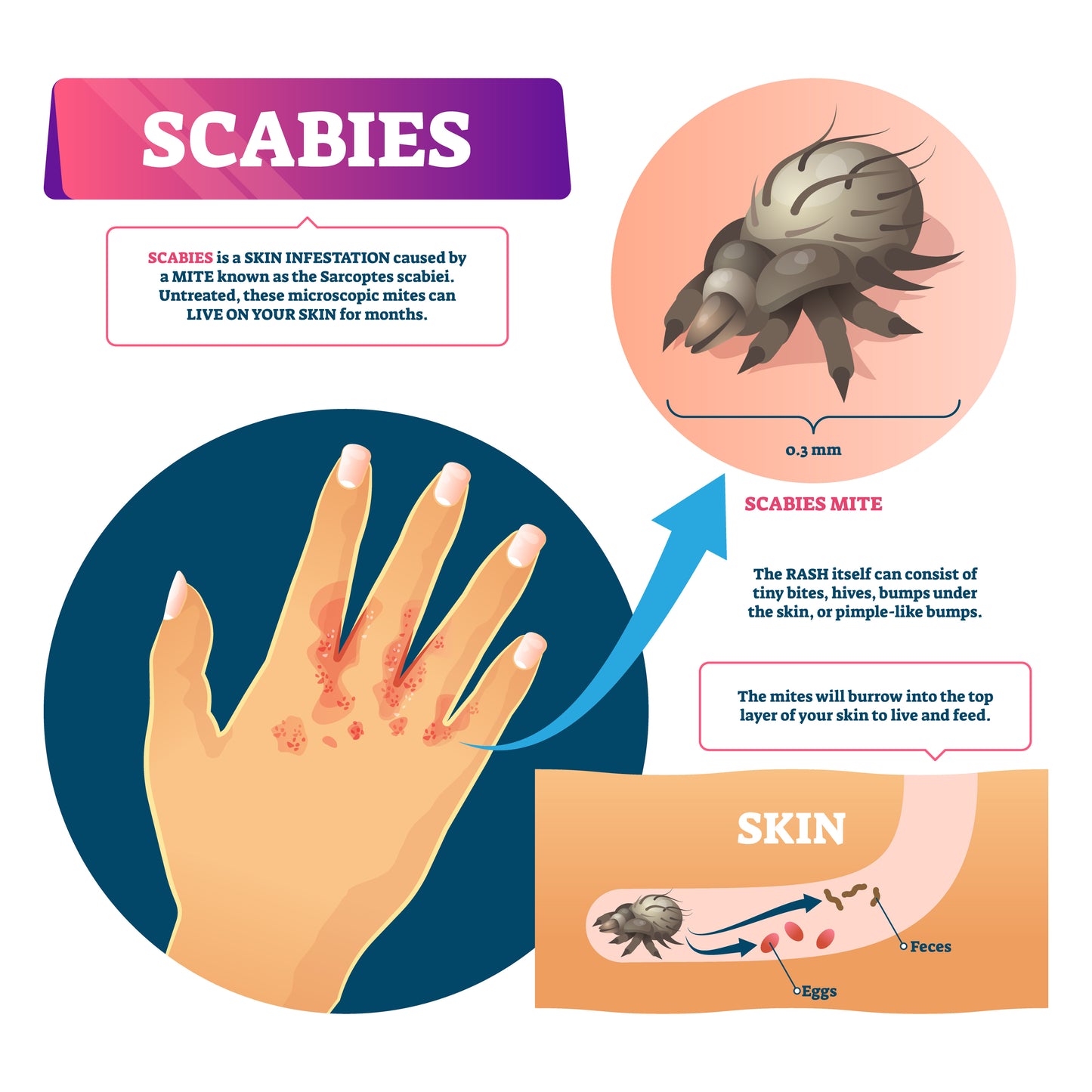 Scabies Treatment Family Pack (1-3 People)