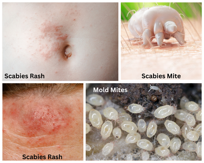 Scabies Relief Treatment Cream | 4 oz Bottle